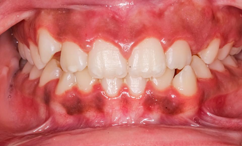 Close-up of a person's open mouth showing teeth and gums, with visible dental condition or irritation
