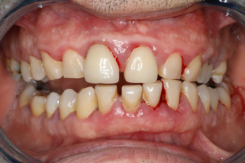 Close-up of a person's open mouth showing upper and lower teeth, some with gaps and uneven alignment, against pink gums