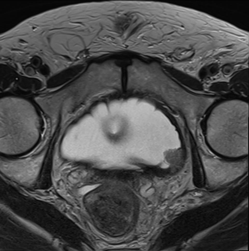 MRI scan showing a cross-section of the pelvic area, highlighting anatomy and internal structures