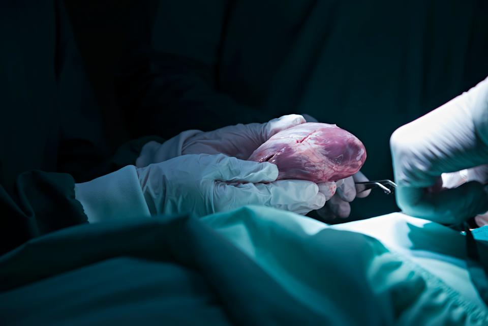 A surgeon's gloved hands hold a human heart during an operation, highlighting a surgical procedure in progress